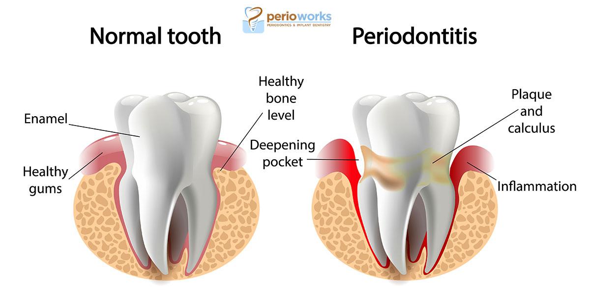 periodontal disease treatment infographic: PerioWorks