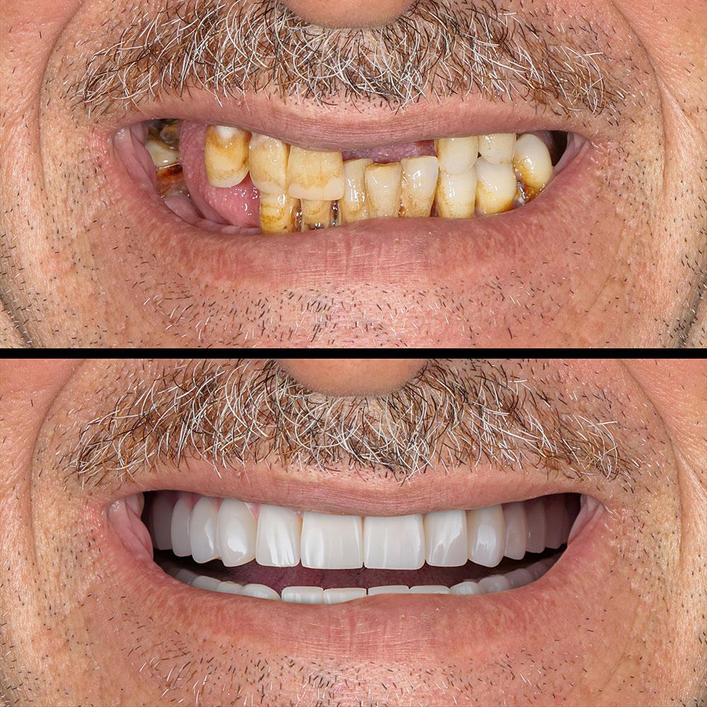 All on four dental implants at PerioWorks