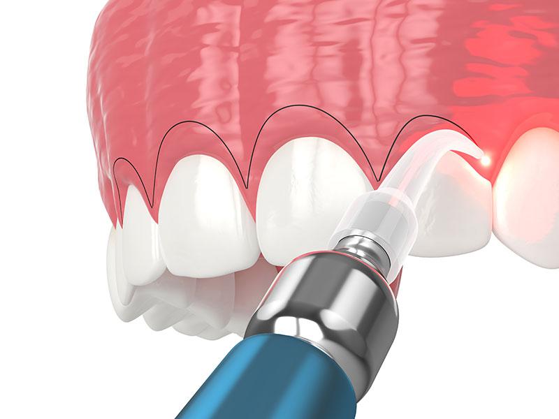 PerioWorks laser gum surgery for periodontitis